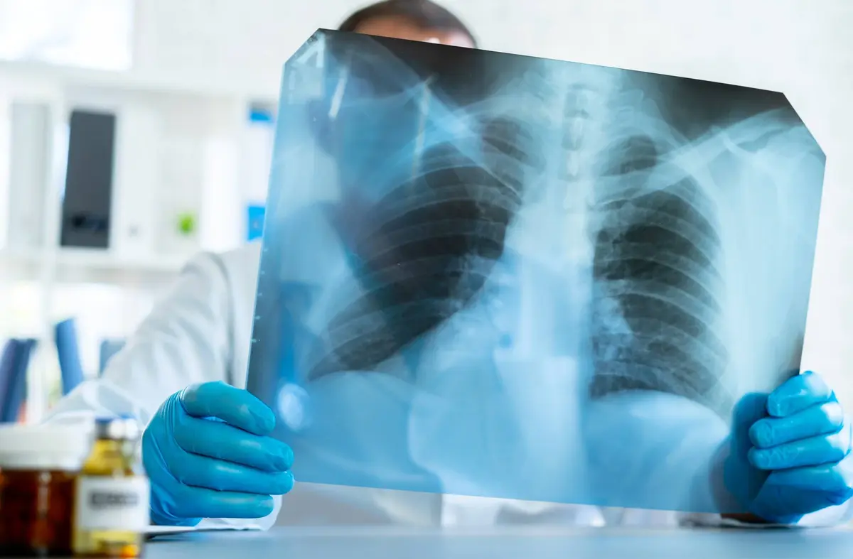 
                        El Hospital Puerta de Hierro de Majadahonda participa en una investigación genómica clave sobre cáncer de pulmón                        